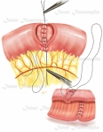 Rafia intestinal