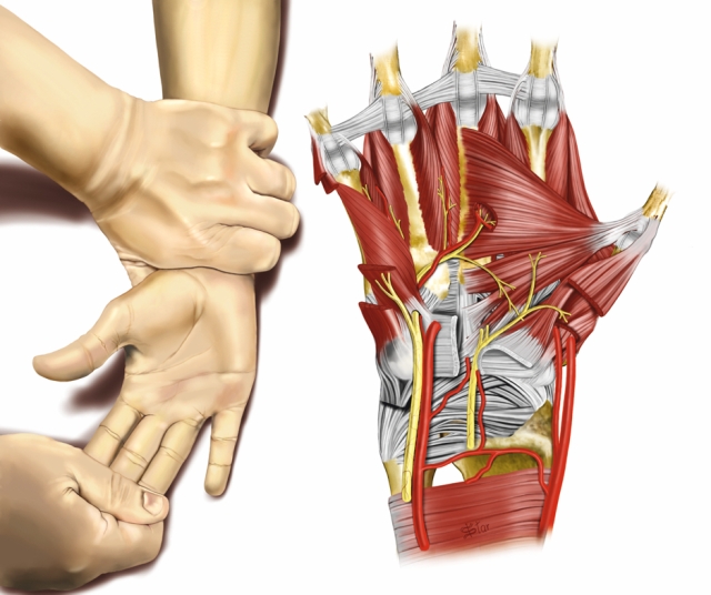 Ilustração mostrando o movimento de pronação do punho para diagnosticar lesão do nervo ulnar.